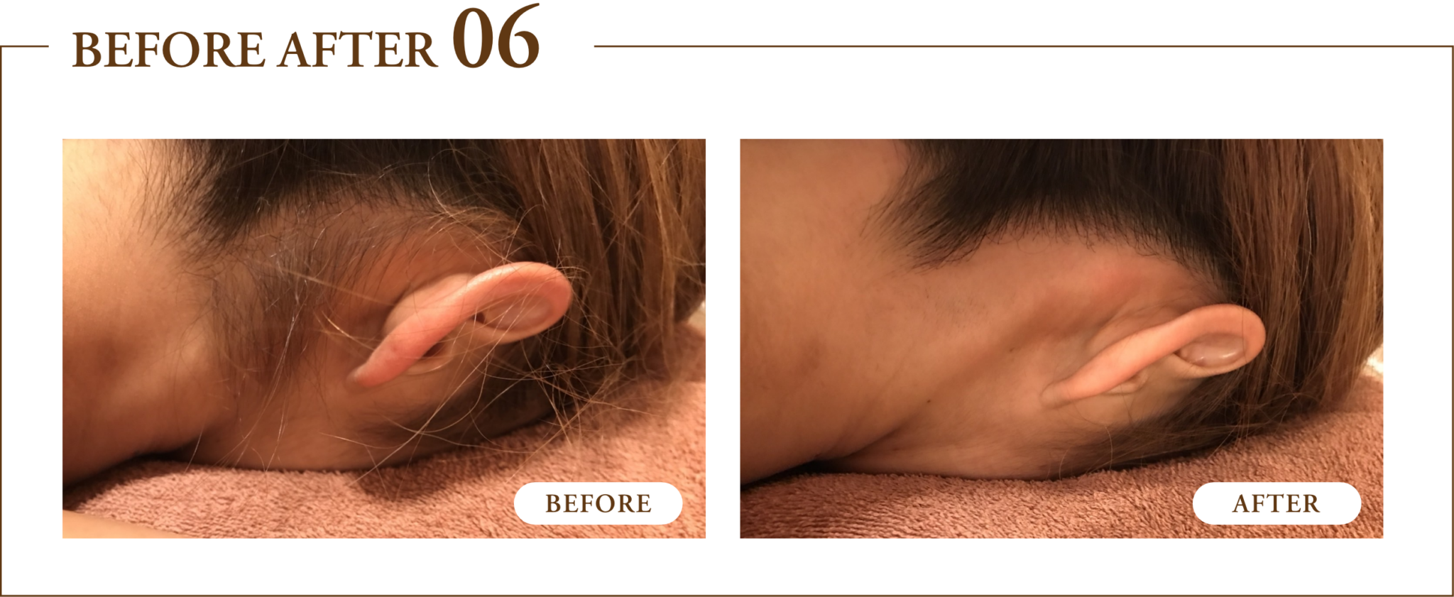 VIO脱毛, W脱毛, ブラジリアンワックス, ルミクス, 脱毛サロン, 美容, 女性, デリケートゾーン, 施術, 信頼, 自由が丘, 東京, 日本